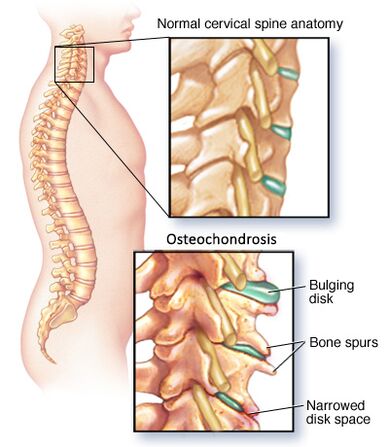dzemdes kakla osteohondroze