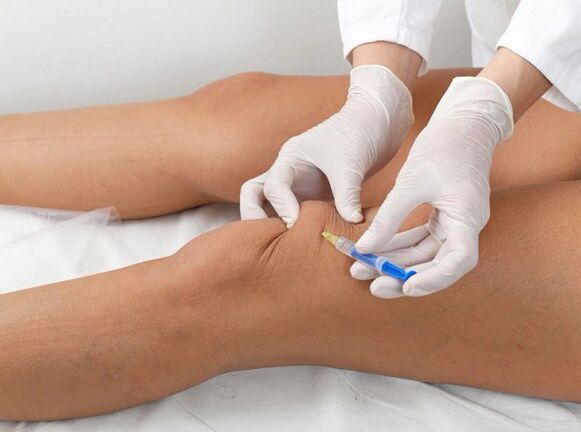 intraartikulāra injekcija ceļa locītavas artrozes gadījumā