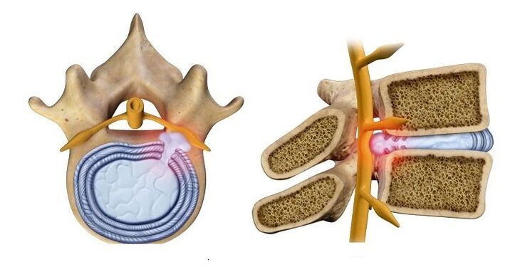 Starpskriemeļu diska trūce – diska kodola izvirzīšanās mugurkaula kanālā